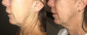 Skin Tightening with Morpheus8 RF Microneedling | Actual Patient Before & After Treatment
